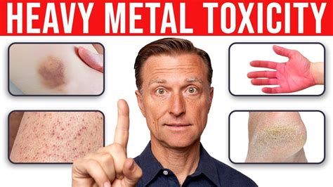 house episode heavy metal poisoning|Bob Palko .